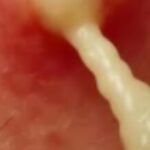 Body Acne, 4 Tips To Get Rid Of Them